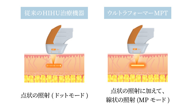従来のHIFU機器と比べて強力アプローチ、痛みの軽減