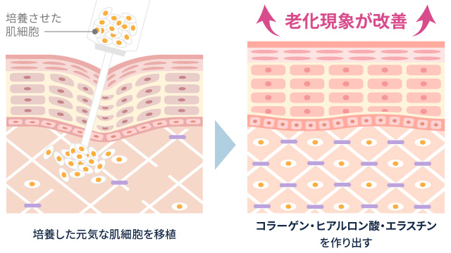 真皮線維芽細胞療法とは