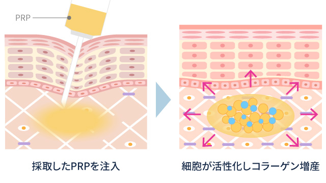 PRP皮膚再生療法とは